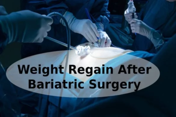 Why is Weight Regain After Bariatric Surgery?